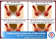 Sa búi trĩ, chữa càng sớm khỏi càng nhanh