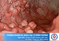 Polyp hậu môn - Dấu hiệu nhận biết và cách hỗ trợ điều trị