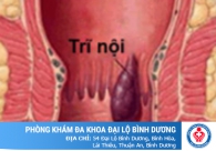 Điều trị bệnh trĩ nội hiệu quả bằng phương pháp cải tiến mới