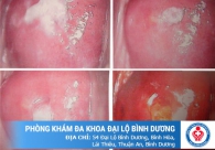 Một số hình ảnh bệnh lậu ở nam và nữ