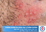 Phòng khám da liễu chuyên điều trị bệnh xã hội tốt ở Bình Dương
