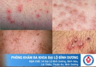 Herpes sinh dục là bệnh gì