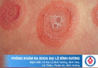 Chảy mủ ở bao quy đầu - Báo hiệu 6 bệnh lý nguy hiểm