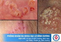Chớ coi thường hiện tượng rát dương vật khi tiểu