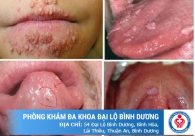 Triệu Chứng Sùi Mào Gà Ở Miệng Và Cách Điều Trị