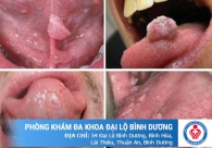 Nhận biết bệnh sùi mào gà như thế nào