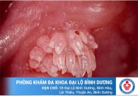 Triệu chứng nhận biết bệnh sùi mào gà ở dương vật