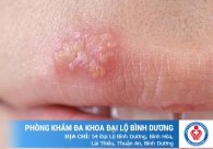Xét nghiệm virus HSV ở đâu đảm bảo tính chính xác nhất