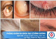 Sùi mào gà ở mắt do đâu