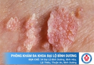 Dấu hiệu sùi mào gà ở nam giới