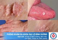 Nguy cơ đối mặt với ung thư do mắc sùi mào gà