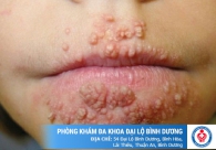 Hỗ trợ điều trị bệnh lậu hiệu quả, an toàn bằng phương pháp DHA cải tiến mới