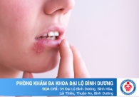 Herpes là gì? Cách điều trị hiệu quả