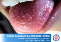 Bạn đã biết gì về bệnh sùi mào gà ở lưỡi