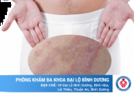 Cảnh giác các bệnh lý nổi mụn ở bìu