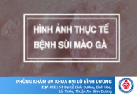 Hình ảnh thực tế về căn bệnh sùi mào gà