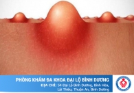 Mọc mụn ở vùng kín là dấu hiệu bệnh gì