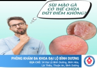 Sùi mào gà ở dương vật và cách trị hiệu quả