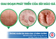 Hình Ảnh Bệnh Sùi Mào Gà Ở Nam Và Nữ