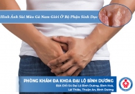 Hình ảnh sùi mào gà nam giới ở bộ phận sinh dục