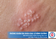 Dương vật nổi hạt, nổi cục cứng, nổi hạch nhỏ là bệnh gì? Tìm hiểu nguyên nhân, dấu hiệu cách trị cùng bác sĩ