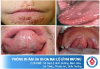 Sùi mào gà ở miệng và những nguy hiểm khôn lường