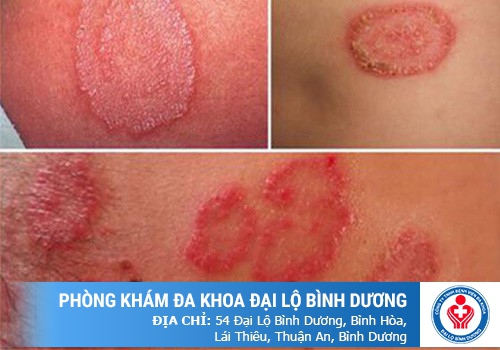 Bệnh lậu có thể gây vô sinh ở cả nam và nữ giới 