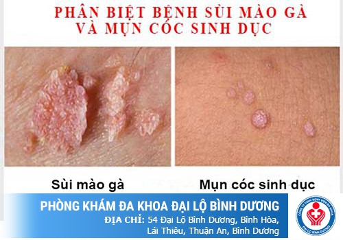 nổi mụn bộ phận sinh dục