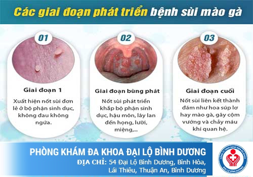Dấu hiệu sùi mào gà ở nam giới