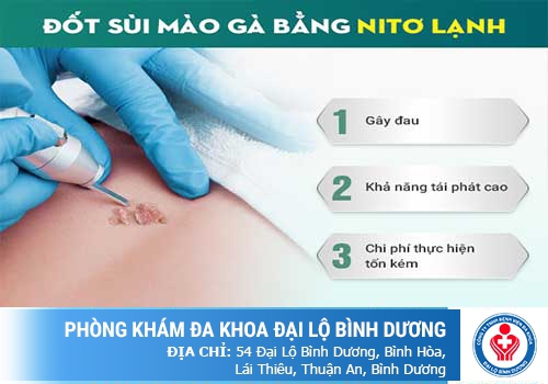 có nên đốt sùi mào gà không