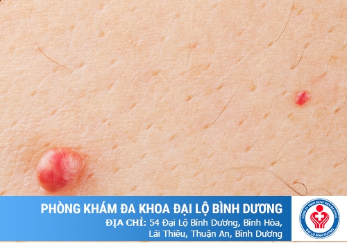 Tư vấn sùi mào gà