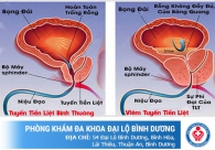 Đi tiểu đau, tiểu khó khăn có phải bị viêm tuyến tiền liệt không
