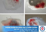 Tinh trùng lẫn máu là gì