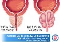 Bệnh phì đại tuyến tiền liệt và cách chữa hiệu quả