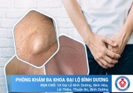 Nổi hạch ở vùng kín là bệnh gì