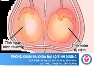 Sưng tinh hoàn là dấu hiệu của bệnh gì