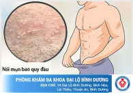 Bao quy đầu nổi mụn là bệnh gì