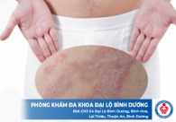 Cách chữa ngứa bìu ở nam giới