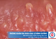 Bệnh sinh dục nam và địa chỉ hỗ trợ điều trị chất lượng tại Bình Dương