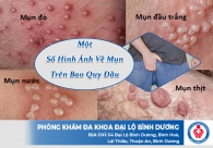 Một Số Hình Ảnh Về Mụn Trên Bao Quy Đầu