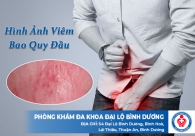 Một số hình ảnh viêm bao quy đầu ở nam giới