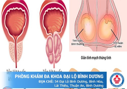 Viêm tinh hoàn