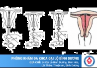 Biện pháp đặt vòng tránh thai an toàn cho phụ nữ