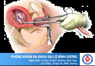Phá thai 2 tháng tuổi bằng phương pháp trực quan siêu dẫn
