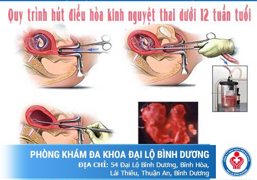 Phá thai bằng phương pháp hút điều hòa kinh nguyệt 