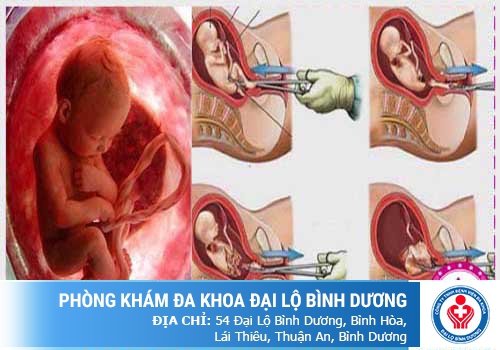 Phá thai 2 tháng tuổi bằng phương pháp trực quan siêu dẫn