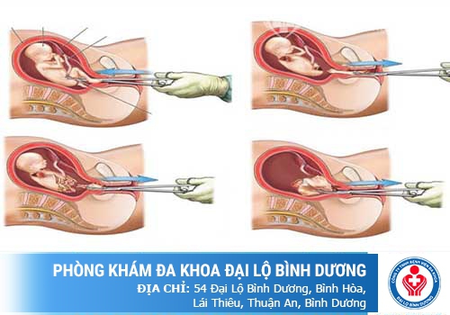 Phương pháp nạo phá thai không đau an toàn