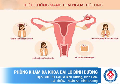 DẤU HIỆU MANG THAI NGOÀI TỬ CUNG