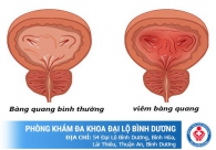 Bệnh Viêm bàng quang cấp ở nữ giới là gì