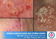 Tình trạng viêm nhiễm ngứa âm đạo do nấm